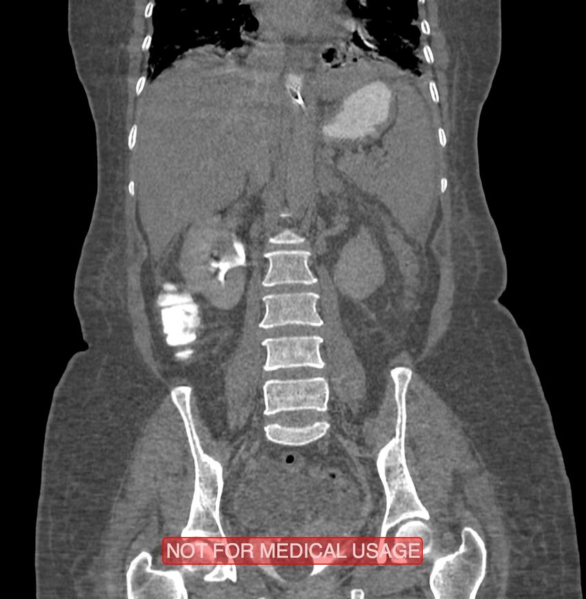 Amoebic enterocolitis with liver abscess (Radiopaedia 35100-36609 B 123).jpg