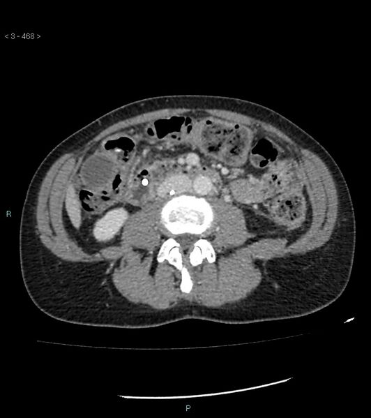 File:Ampulla of Vater metastasis (Radiopaedia 27820-28069 A 106).jpg