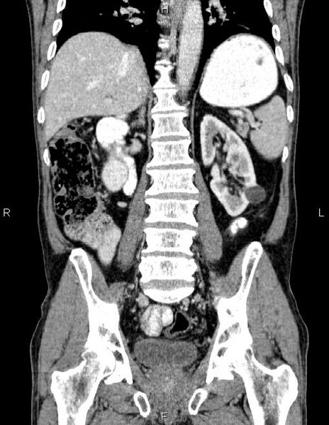 File:Ampullary adenocarcinoma (Radiopaedia 86093-102032 C 43).jpg