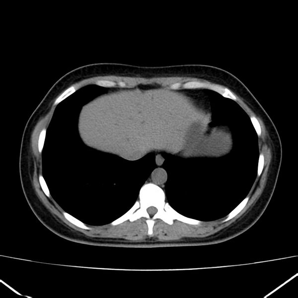 File:Ampullary tumor (Radiopaedia 22787-22816 Axial non-contrast 5).jpg