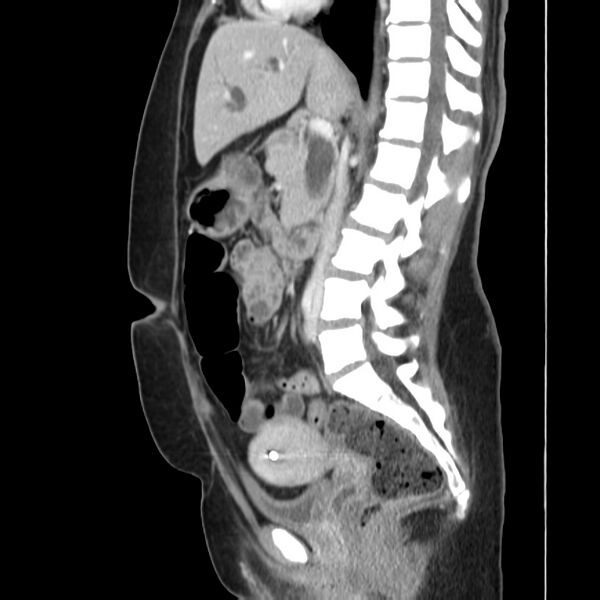 File:Ampullary tumor (Radiopaedia 22787-22816 D 28).jpg