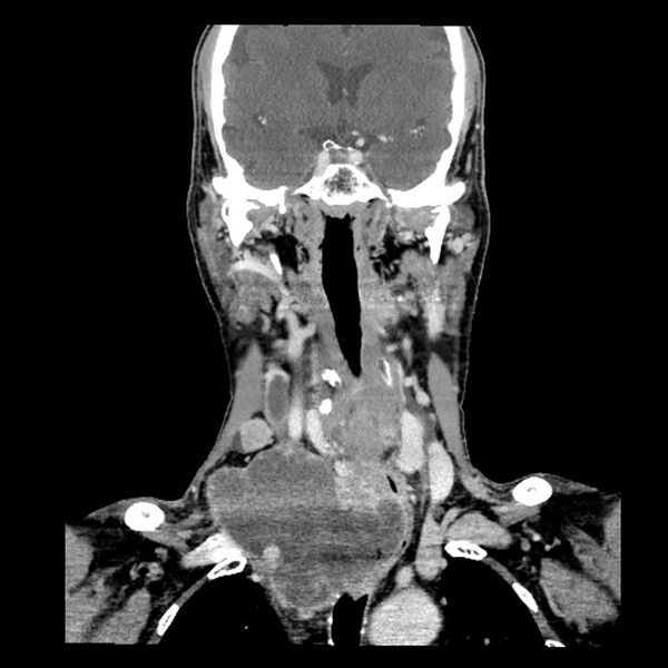File:Anaplastic thyroid carcinoma (Radiopaedia 79087-92034 A 62).jpg