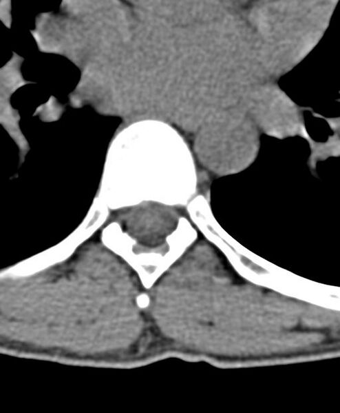 File:Aneurysmal bone cyst T11 (Radiopaedia 29294-29721 Axial non-contrast 9).jpg