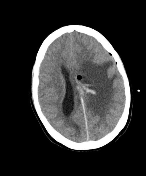 File:Angiomatous meningioma (Radiopaedia 79459-92578 Axial non-contrast 19).jpg