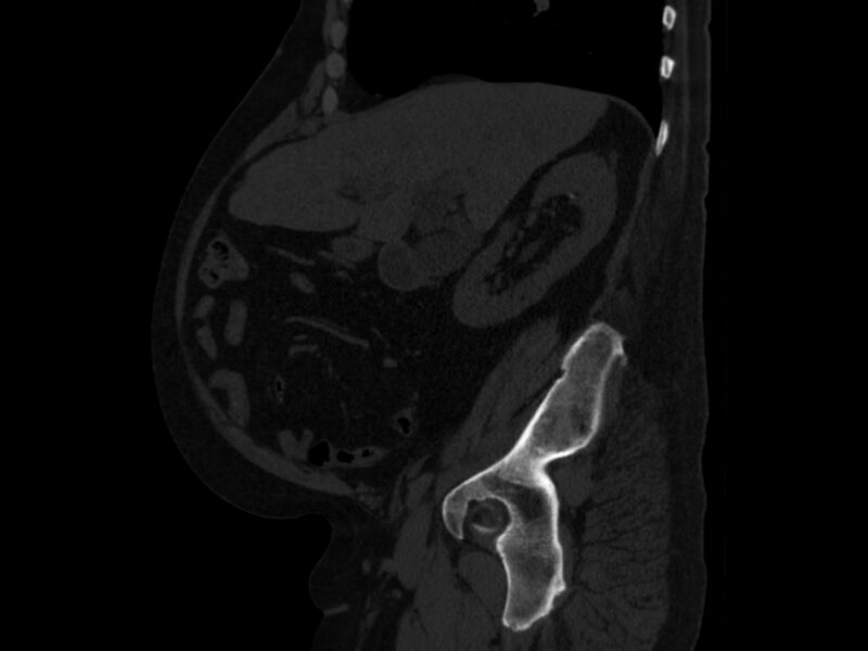 File:Ankylosing spondylitis (Radiopaedia 44609-48357 Sagittal bone window 31).jpg
