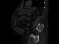 Ankylosing spondylitis (Radiopaedia 44609-48357 Sagittal bone window 72).jpg