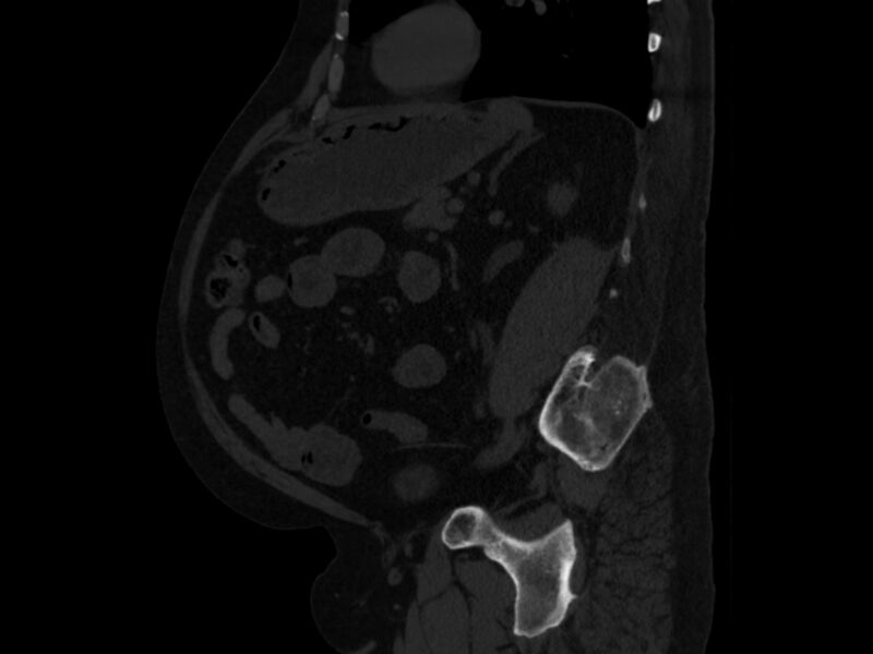File:Ankylosing spondylitis (Radiopaedia 44609-48357 Sagittal bone window 72).jpg