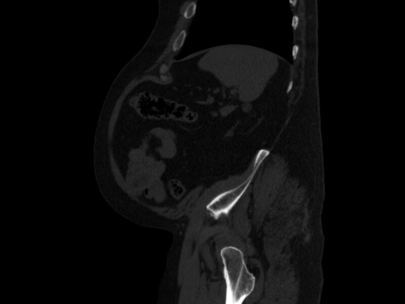 File:Ankylosing spondylitis (Radiopaedia 44609-48357 Sagittal bone window 94).jpg