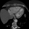 Anomalous origin of left circumflex artery from right coronary sinus (Radiopaedia 72563-83117 B 137).jpg