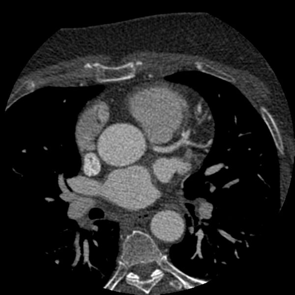 File:Anomalous origin of left circumflex artery from right coronary sinus (Radiopaedia 72563-83117 B 37).jpg