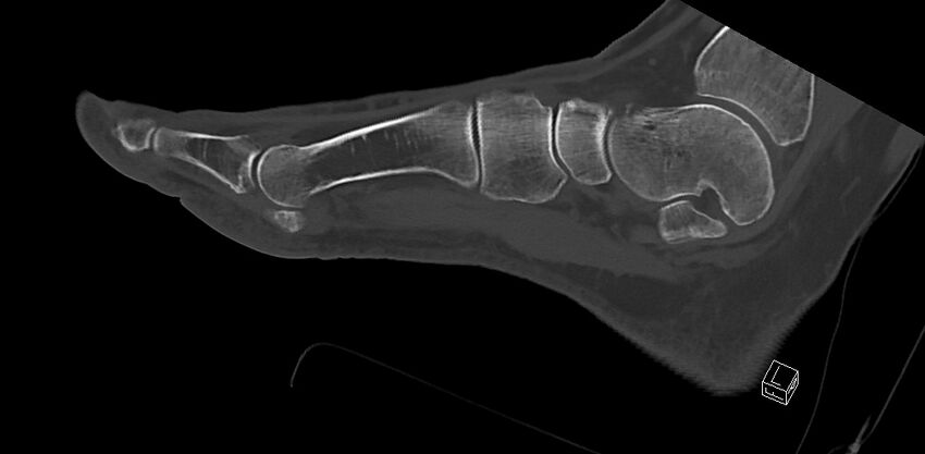 Anterior calcaneal process fracture (Radiopaedia 63353-71943 C 45).jpg
