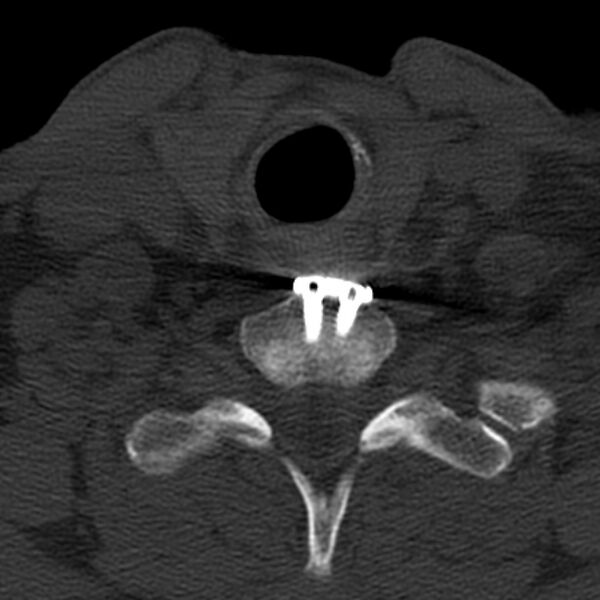 File:Anterior cervical postdiscectomy arthrodesis (Radiopaedia 32678-33646 Axial bone window 62).jpg