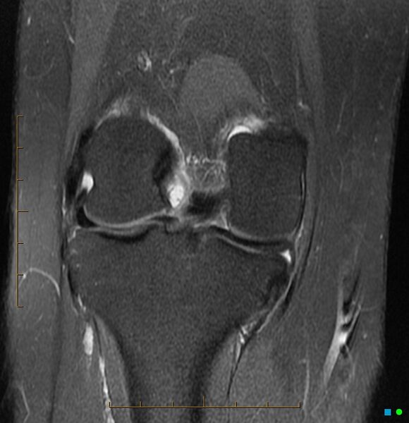 File:Anterior cruciate ligament ganglion cyst (Radiopaedia 3582-6491 Coronal PD fat sat 4).jpg