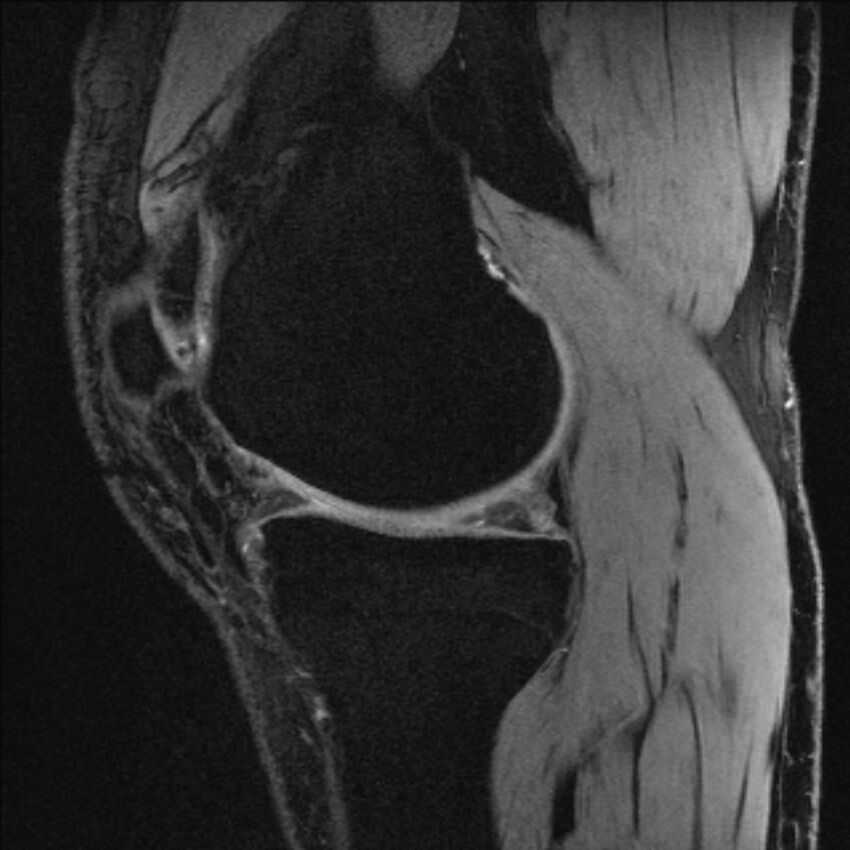 Anterior cruciate ligament mucoid degeneration (Radiopaedia 68400-77933 Sagittal 44).jpg