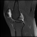 Anterior cruciate ligament tear, Wrisberg rip and bucket-handle tear of medial meniscus (Radiopaedia 75872-87266 Sagittal PD fat sat 16).jpg
