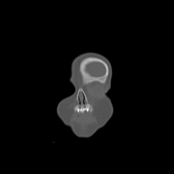File:Anterior plagiocephaly (Radiopaedia 71836-82273 Coronal bone window 21).jpg