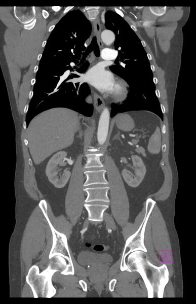 File:Aortectomy and axillary-bifemoral bypass (Radiopaedia 28303-28545 C 54).jpg