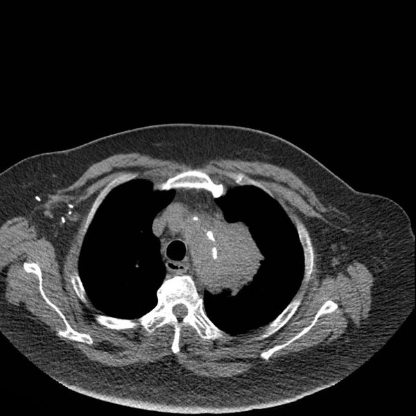 File:Aortic arch false aneurysm (Radiopaedia 14667-14587 Axial non-contrast 6).jpg