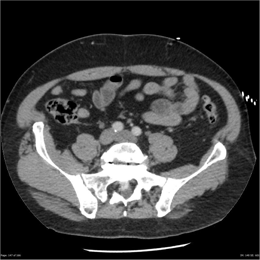 Aortic dissection- Stanford A (Radiopaedia 37759-39664 A 138).jpg