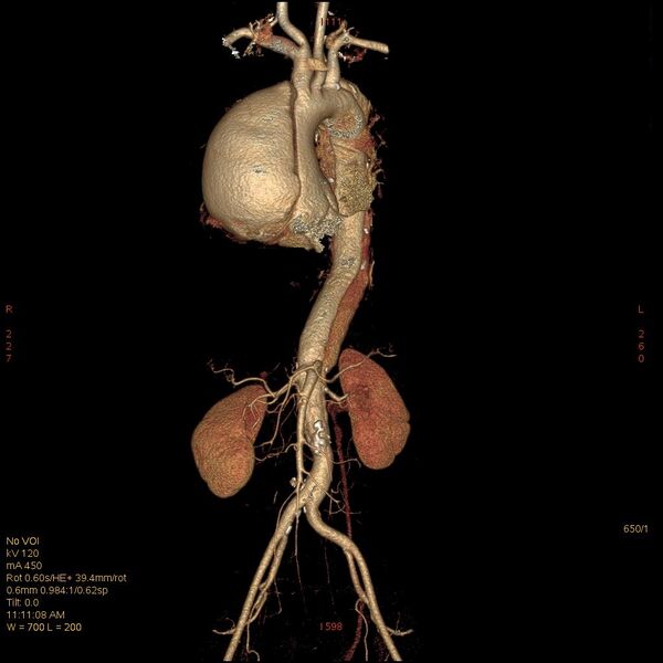File:Aortic dissection (Radiopaedia 25350-25604 E 1).jpg