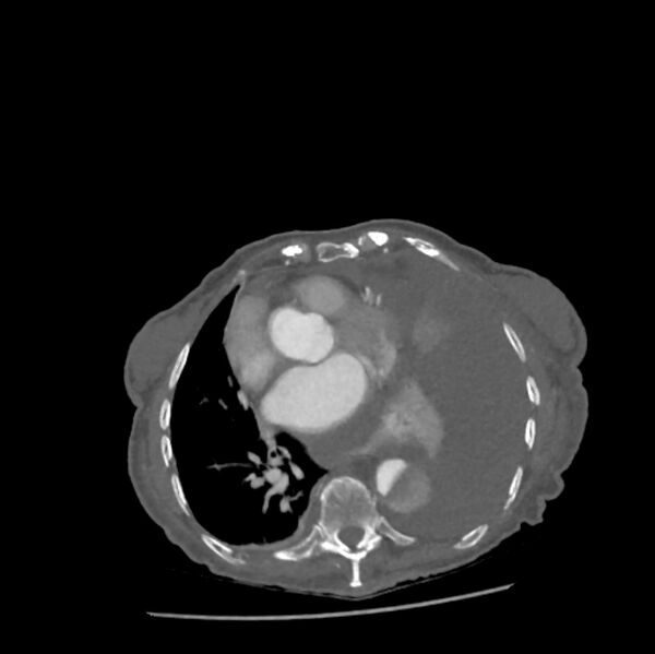 File:Aortic dissection (Radiopaedia 68763-78691 A 34).jpeg