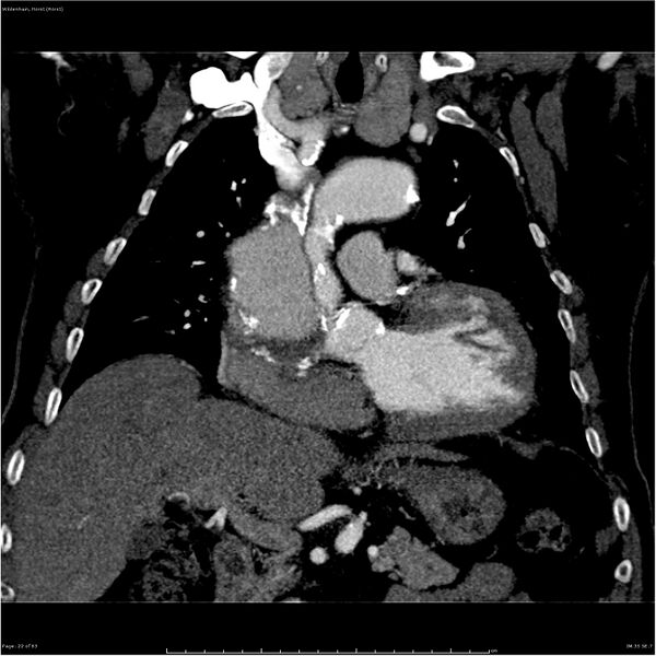 File:Aortic dissection - Stanford type A (Radiopaedia 26183-26315 A 22).jpg