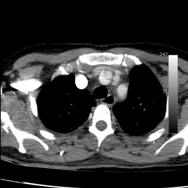 File:Aortic dissection - Stanford type A (Radiopaedia 29247-29659 A 17).jpg