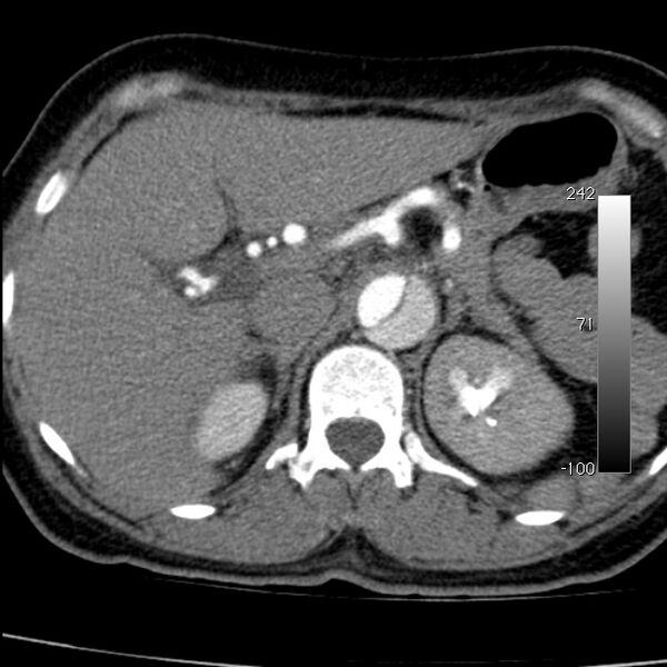 File:Aortic dissection - Stanford type A (Radiopaedia 29247-29659 A 80).jpg