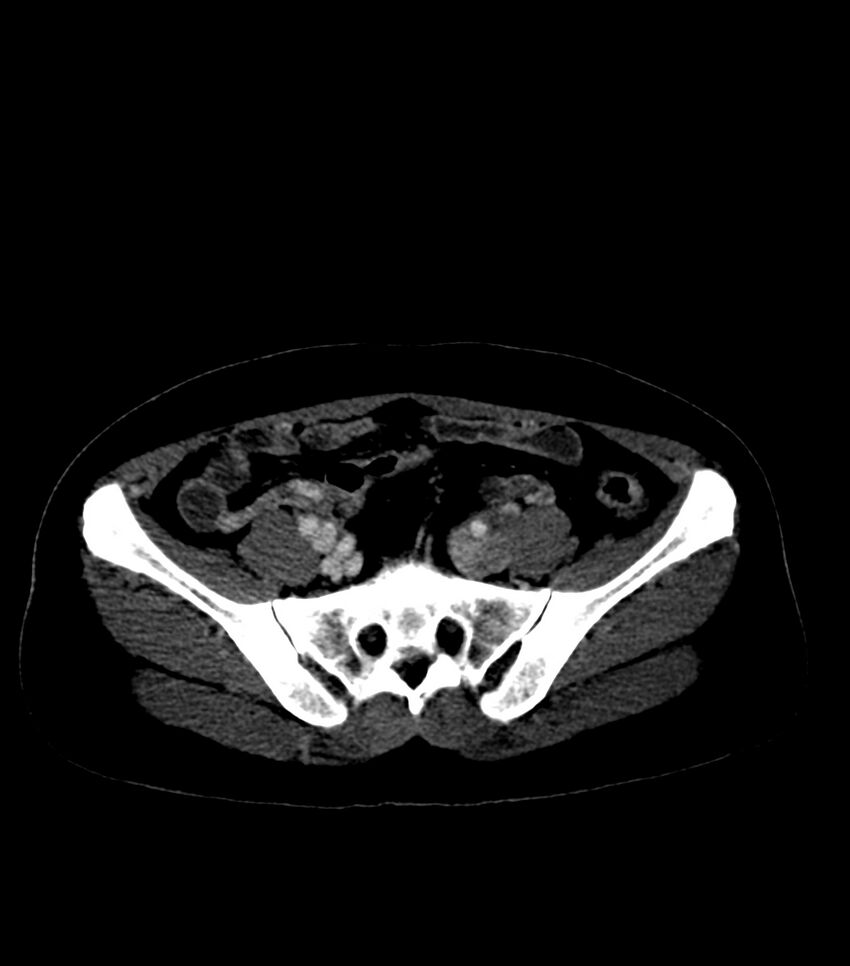 Aortic dissection with renal ischemia (Radiopaedia 76573-88338 B 52).jpg
