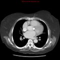 Aortic valve stenosis (Radiopaedia 14480-14423 C 5).jpg