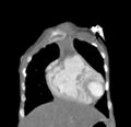 Aortopulmonary window, interrupted aortic arch and large PDA giving the descending aorta (Radiopaedia 35573-37074 D 9).jpg
