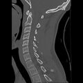 Apical pneumothorax on cervical spine CT (Radiopaedia 45343-49368 Sagittal bone window 14).jpg