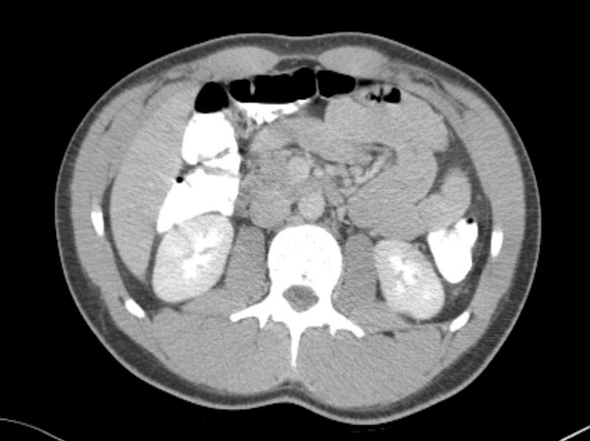 Appendicitis and incidental foregut duplication cyst (Radiopaedia 52962-58916 A 23).jpg