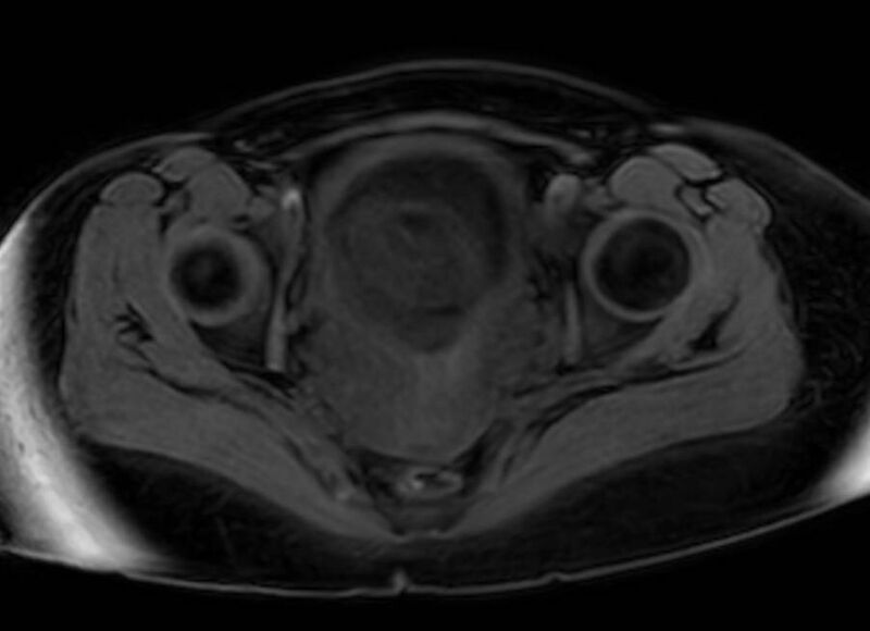 File:Appendicitis in gravida (MRI) (Radiopaedia 89433-106395 Axial DIXON 136).jpg
