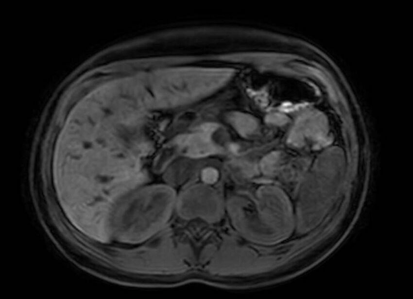 Appendicitis in gravida (MRI) (Radiopaedia 89433-106395 Axial DIXON 39).jpg