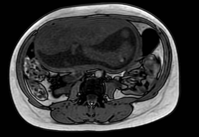 File:Appendicitis in gravida (MRI) (Radiopaedia 89433-106395 D 33).jpg
