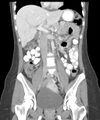Appendicitis with minimal stranding but appendicolith (Radiopaedia 29035-29397 B 20).jpg