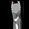 Appendicitis with phlegmon (Radiopaedia 9358-10046 F 1).jpg