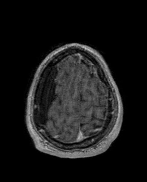 File:Arachnoid cyst- extremely large (Radiopaedia 68741-78451 Axial T1 C+ 70).jpg