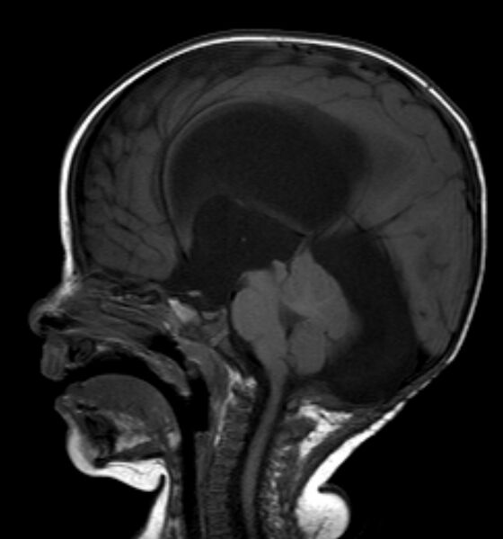 File:Arachnoid cyst of the posterior fossa with hydrocephalus (Radiopaedia 5682-7389 Sagittal T1 1).jpg