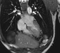 Arrhythmogenic right ventricular cardiomyopathy (Radiopaedia 39806-42237 D 121).jpg