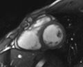 Arrhythmogenic right ventricular cardiomyopathy (Radiopaedia 69564-79464 short axis cine 121).jpg