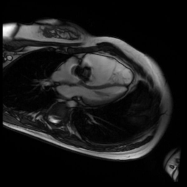 File:Arrhythmogenic right ventricular cardiomyopathy (Radiopaedia 87505-103850 4ch Cine SSFP 77).jpg