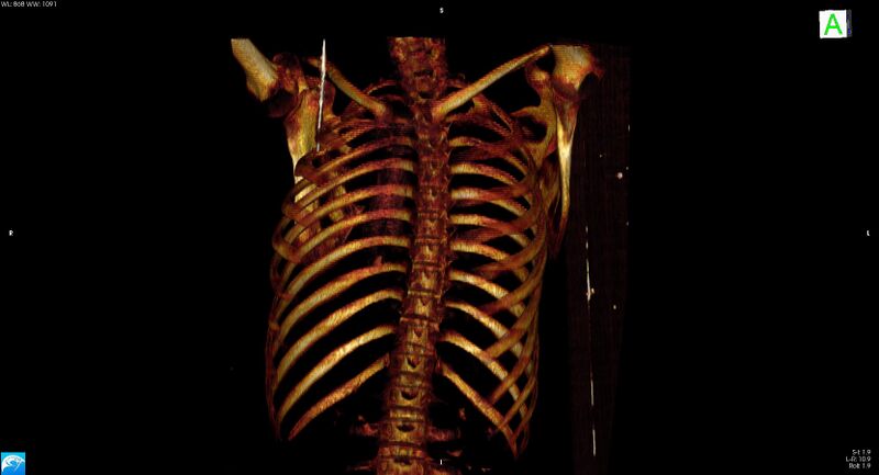 File:Arrow injury to the neck (Radiopaedia 75225-86323 3D bone 3).jpg