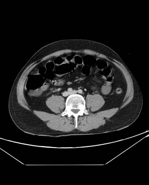 File:Arterial occlusive mesenteric ischemia (Radiopaedia 84641-100054 A 74).jpg