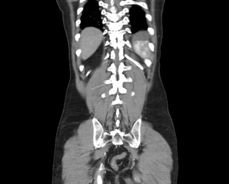 File:Arterial occlusive mesenteric ischemia (Radiopaedia 84641-100060 B 47).jpg