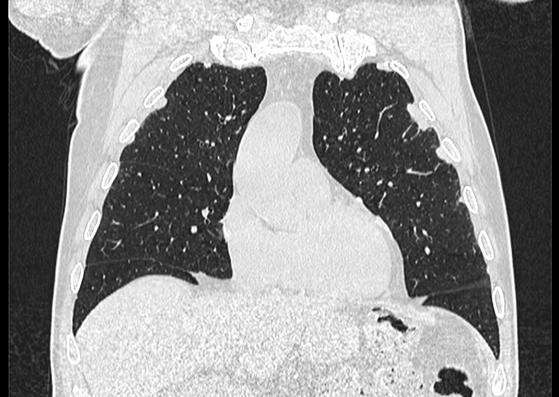 File:Asbestos pleural placques (Radiopaedia 57905-64872 Coronal lung window 86).jpg