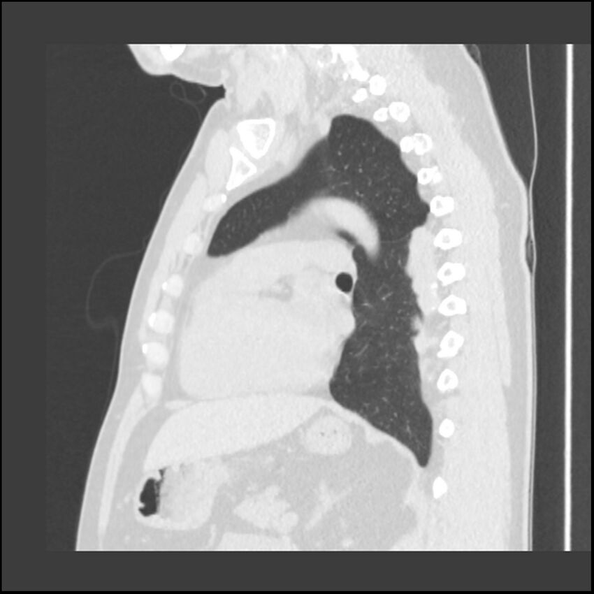 Asbestosis (Radiopaedia 45002-48961 Sagittal lung window 53).jpg