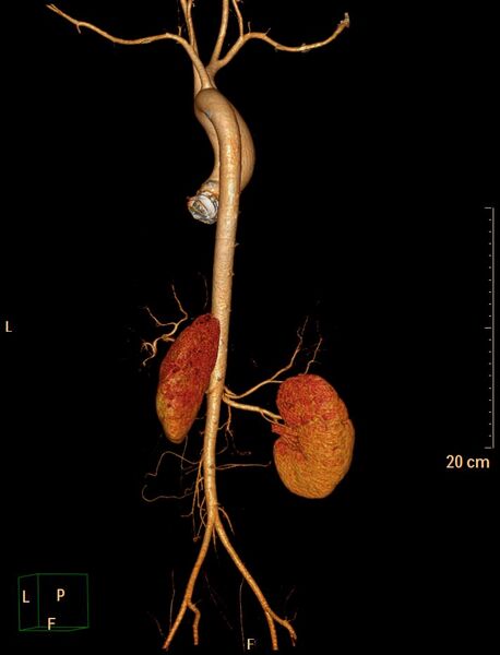 File:Ascending aortic pseudoaneurysm (Radiopaedia 28638-28910 D 19).jpg