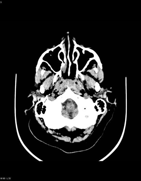 File:Astroblastoma (Radiopaedia 39792-42216 Axial non-contrast 4).jpg
